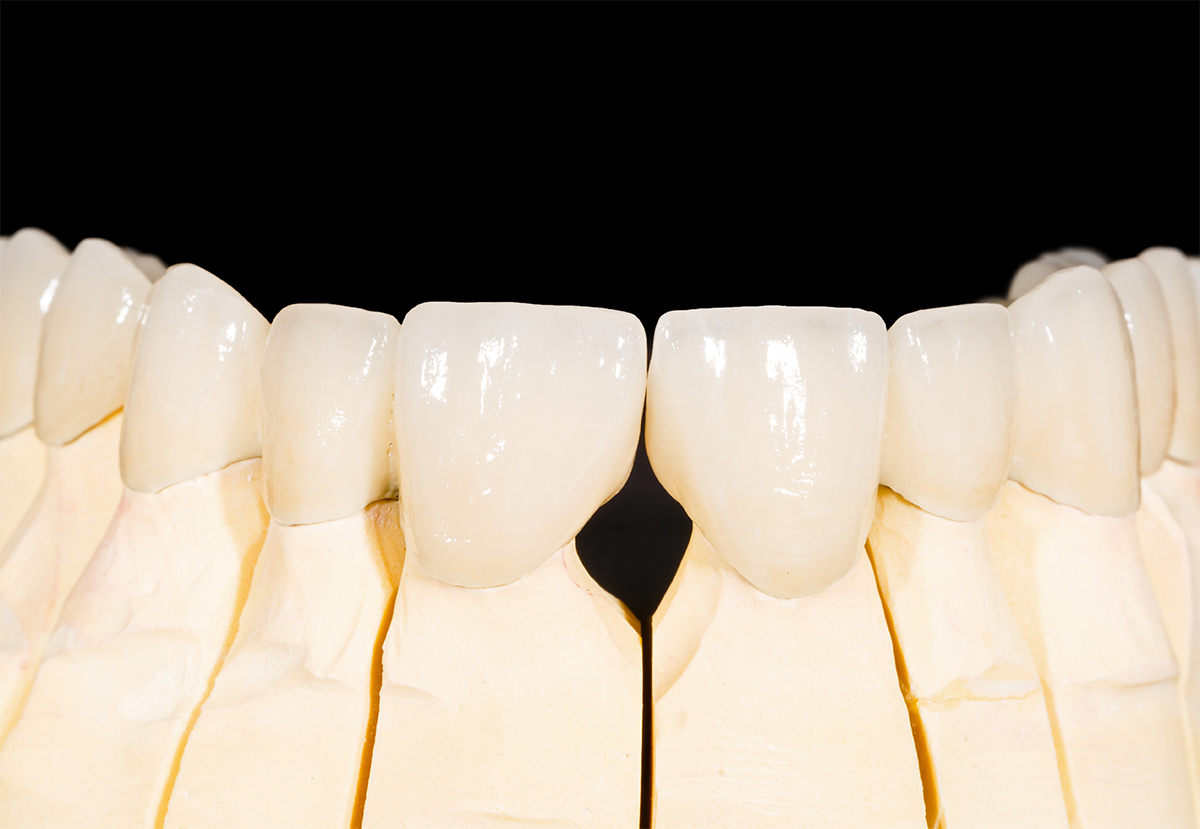 Metal-Free Dental Implants